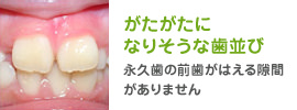 がたがたになりそうな歯並び